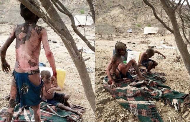 YEMEN: A Genocidal War Against Children and Civilians Sanctioned by the UN, US, UK & NATO